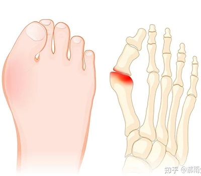 Hallux Valgus: Potpuni naučni vodič