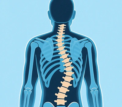 Scoliosis: Xianku 3D skener karoserije, 3D + AI, prevencija i korekcija skolioze