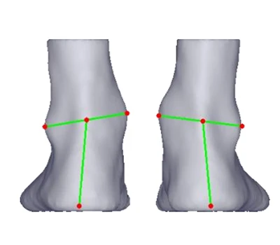 Valgus i varus peta: tiha prijetnja preko