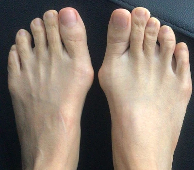 Mjerenje Hallux Valgusa: Zašto 3D skeneri nadmašuju kliničare i bolnice