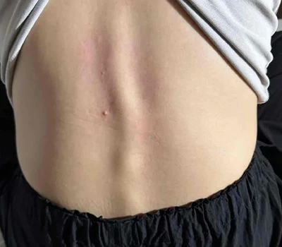 Sveobuhvatna analiza skolioze: razumijevanje stanja i tehnoloških inovacija u procjeni i upravljanju